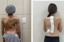 SESA - Paraná é referência em cirurgias de deformidade da coluna vertebral