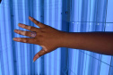 SESA - ​Hospital Dermatológico é referência no tratamento integral e gratuito de vitiligo