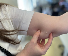 SESA - Implante contraceptivo de até R$ 4 mil chega gratuitamente ao SUS no PR