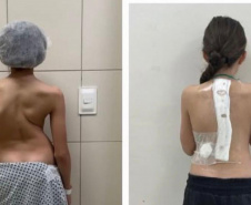 SESA - Paraná é referência em cirurgias de deformidade da coluna vertebral