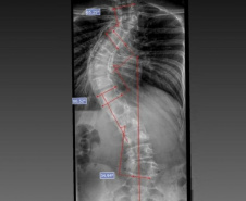 SESA - Paraná é referência em cirurgias de deformidade da coluna vertebral