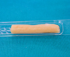 Procedimento com uso de biovidro no tratamento de infecção óssea é realizado pela primeira vez no HU-UEL