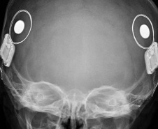 Paraná assume liderança nacional em implantes cocleares pelo SUS