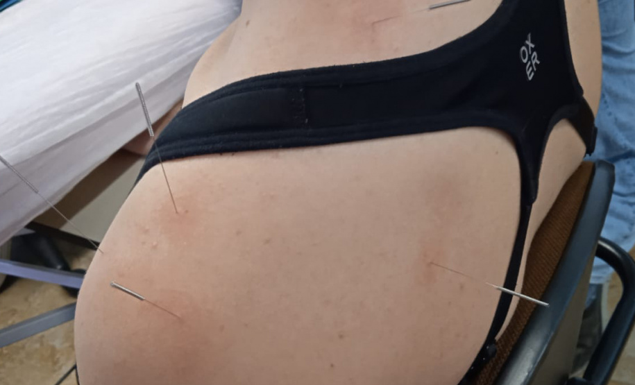 Paraná forma médicos da Atenção Primária para atuar com acupuntura no SUS