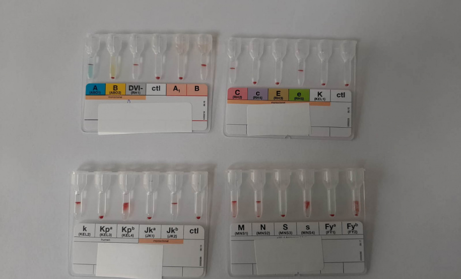 Tratamento especializado ofertado pelo Hemepar amplia qualidade de vida de pacientes com Anemia Falciforme e Talassemia