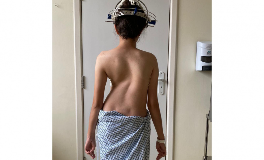 Junho Verde alerta sobre o diagnóstico e tratamento precoce da escoliose