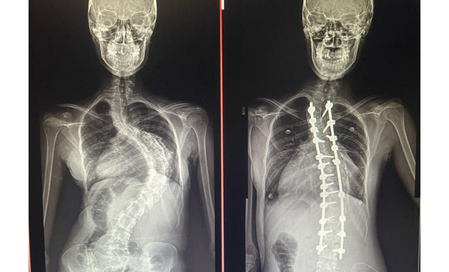Junho Verde alerta sobre o diagnóstico e tratamento precoce da escoliose