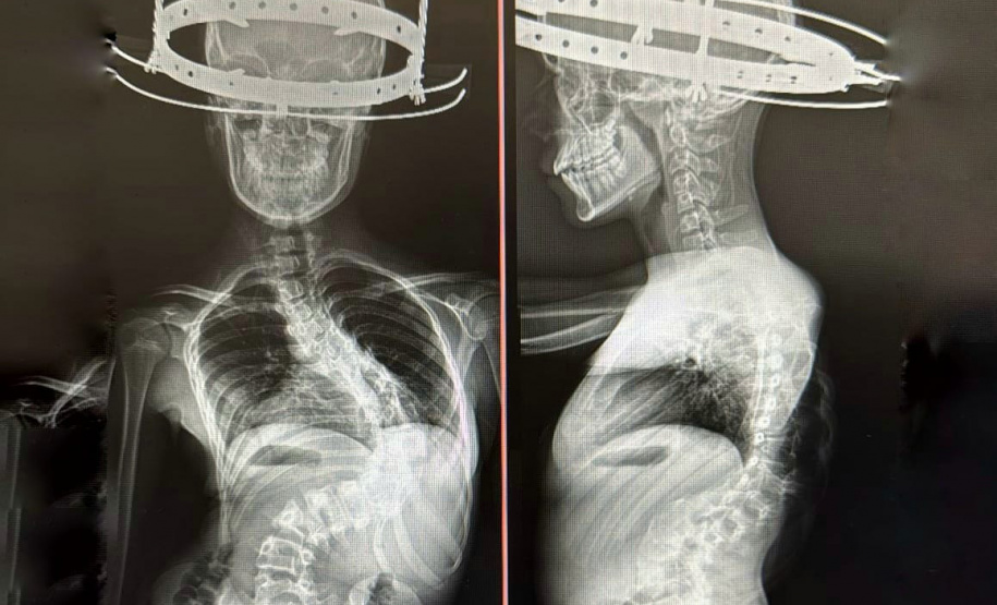 Complexo do Trabalhador já fez 117 cirurgias para correção de deformidades pediátricas