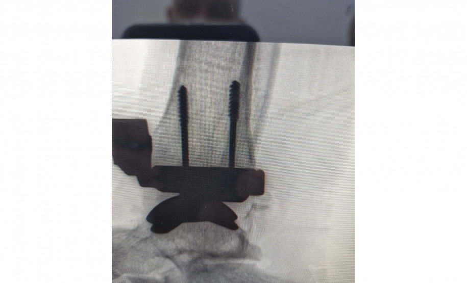 Paraná registra primeira cirurgia de artroplastia de tornozelo feita pelo SUS