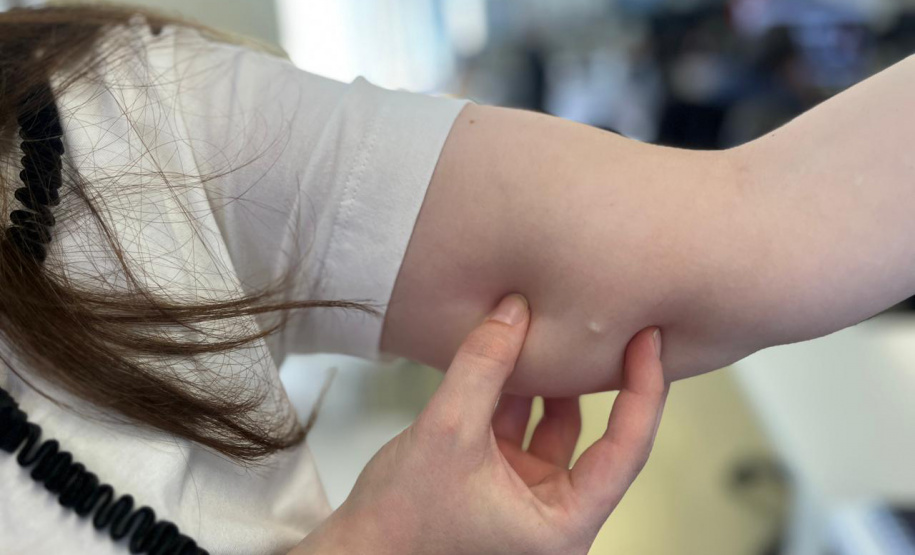 SESA - Implante contraceptivo de até R$ 4 mil chega gratuitamente ao SUS no PR