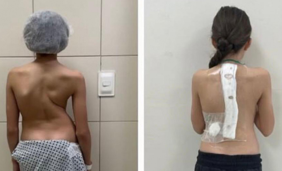 SESA - Paraná é referência em cirurgias de deformidade da coluna vertebral