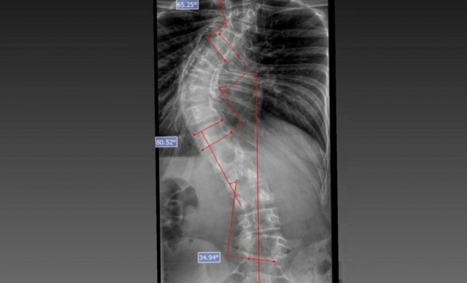SESA - Paraná é referência em cirurgias de deformidade da coluna vertebral