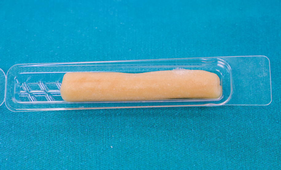 Procedimento com uso de biovidro no tratamento de infecção óssea é realizado pela primeira vez no HU-UEL