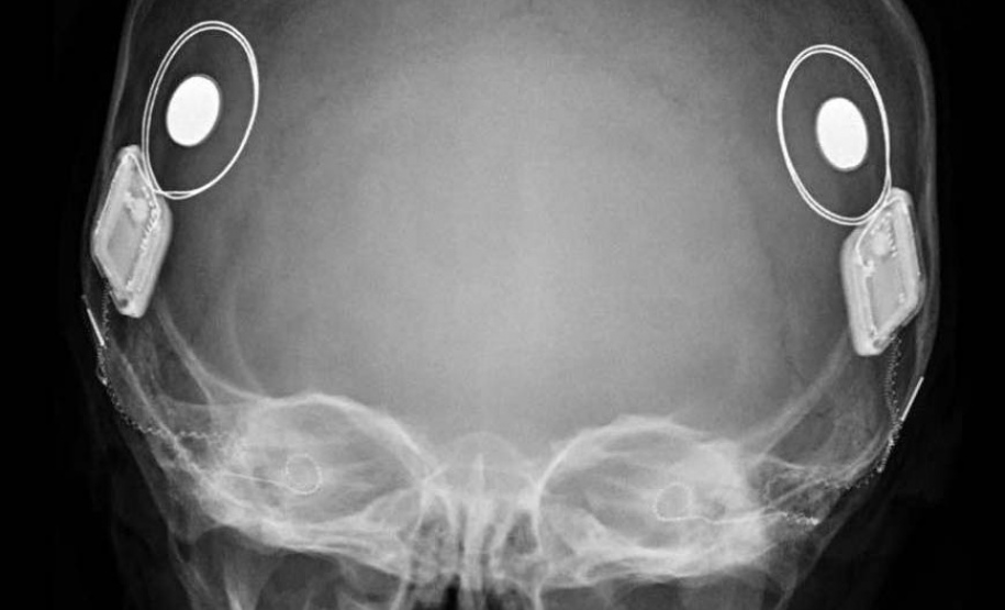 Paraná assume liderança nacional em implantes cocleares pelo SUS