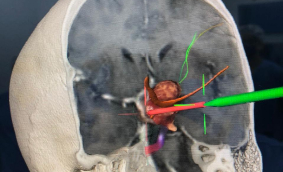 Foi realizada hoje (12), no Complexo do Hospital do Trabalhador, a primeira cirurgia computadorizada utilizando equipamento de última geração adquirido com recursos da Secretaria de Estado da Saúde, repassados do Ministério Público do Trabalho.
Foto:SESA