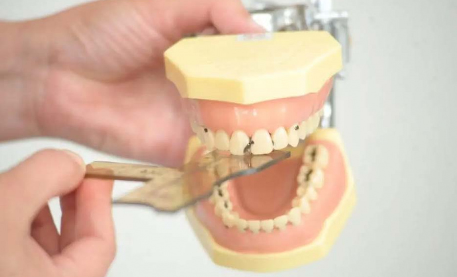 A Universidade Estadual de Londrina (UEL) oficializou nesta sexta-feira (10) um contrato de licenciamento de tecnologia com a Indusbello Company, de Londrina, para produção e comercialização de três réguas específicas para auxiliar cirurgiões dentistas no trabalho de recuperação de dentes. Foto: UEL